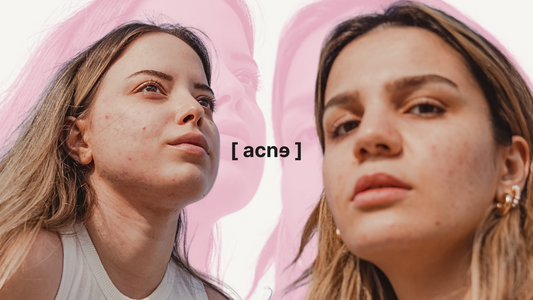 How to Combat Acne: Tips and Recommended Products